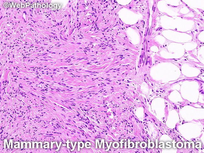 Mammarytype Myofibroblastoma_resized.jpg